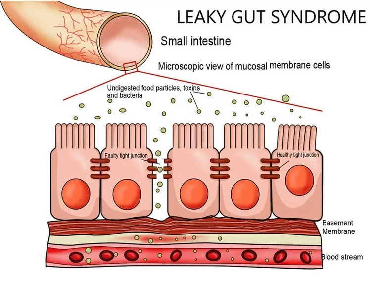 leaky gut syndrome